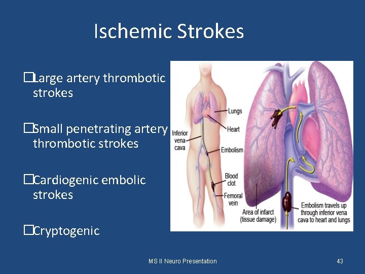 Ischemic Strokes �Large artery thrombotic strokes �Small penetrating artery thrombotic strokes �Cardiogenic embolic strokes