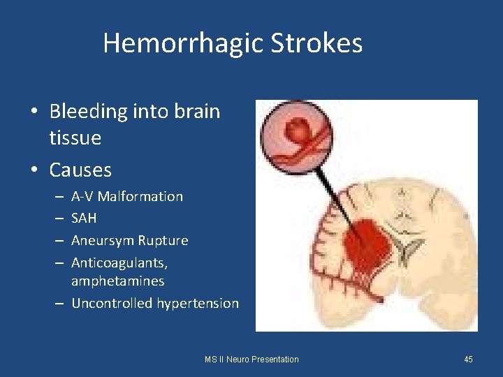 Hemorrhagic Strokes • Bleeding into brain tissue • Causes A-V Malformation SAH Aneursym Rupture
