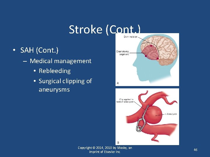 Stroke (Cont. ) • SAH (Cont. ) – Medical management • Rebleeding • Surgical