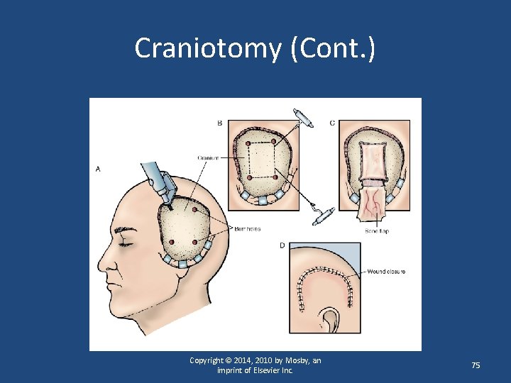 Craniotomy (Cont. ) Copyright © 2014, 2010 by Mosby, an imprint of Elsevier Inc.