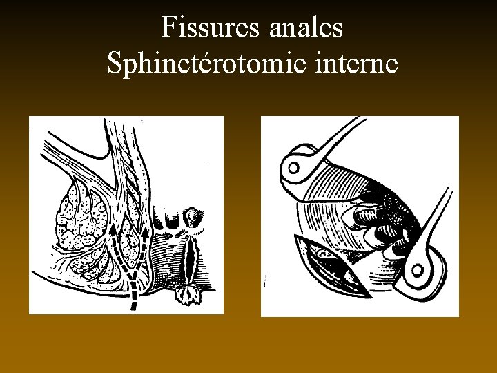 Fissures anales Sphinctérotomie interne 