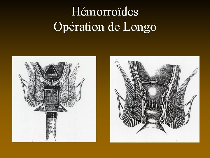 Hémorroïdes Opération de Longo 