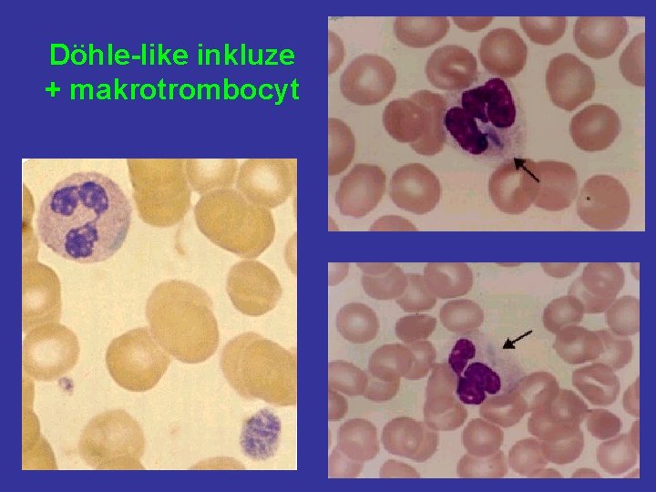 Döhle-like inkluze + makrotrombocyt 