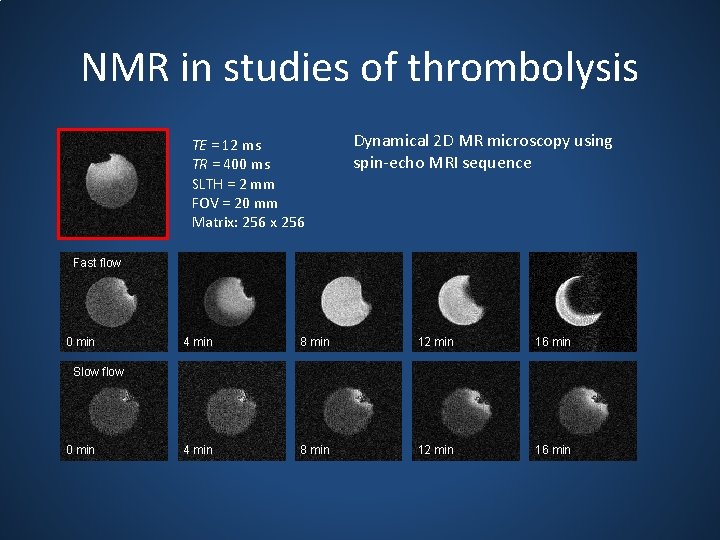 NMR in studies of thrombolysis TE = 12 ms TR = 400 ms SLTH