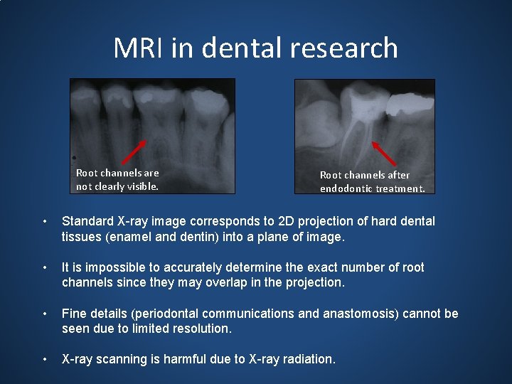 MRI in dental research Root channels are not clearly visible. Root channels after endodontic