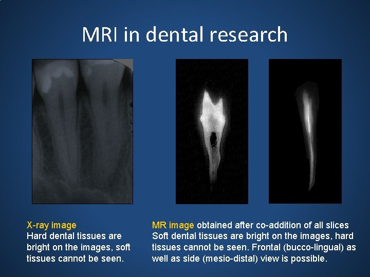 MRI in dental research X-ray image Hard dental tissues are bright on the images,
