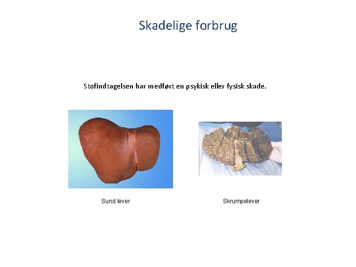 Skadelige forbrug Stofindtagelsen har medført en psykisk eller fysisk skade. Sund lever Skrumpelever 