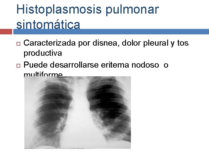 Histoplasmosis pulmonar sintomática Caracterizada por disnea, dolor pleural y tos productiva Puede desarrollarse eritema