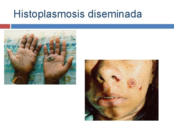 Histoplasmosis diseminada 