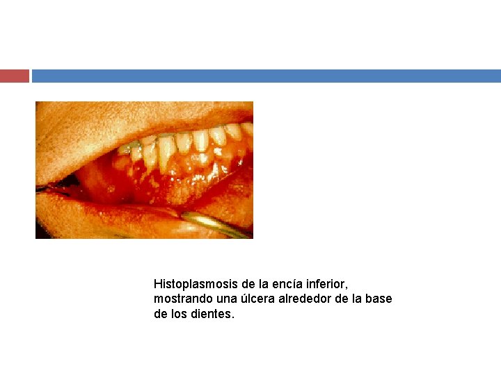 Histoplasmosis de la encía inferior, mostrando una úlcera alrededor de la base de los