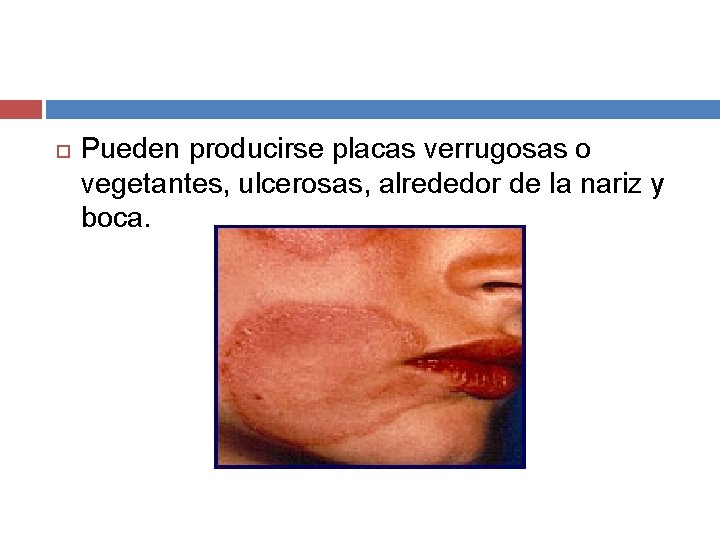  Pueden producirse placas verrugosas o vegetantes, ulcerosas, alrededor de la nariz y boca.