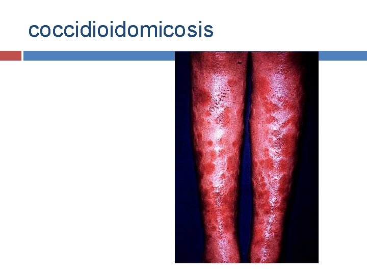 coccidioidomicosis 