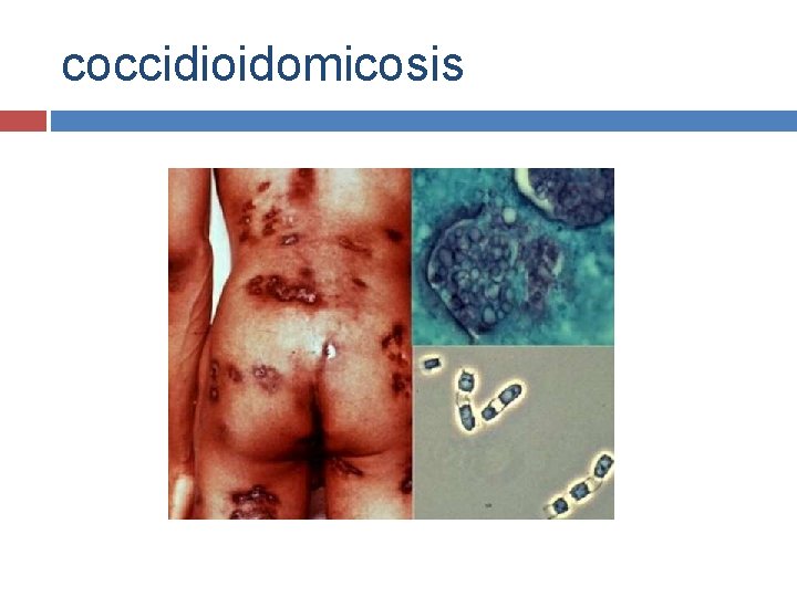 coccidioidomicosis 