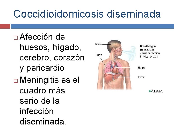 Coccidioidomicosis diseminada Afección de huesos, hígado, cerebro, corazón y pericardio Meningitis es el cuadro