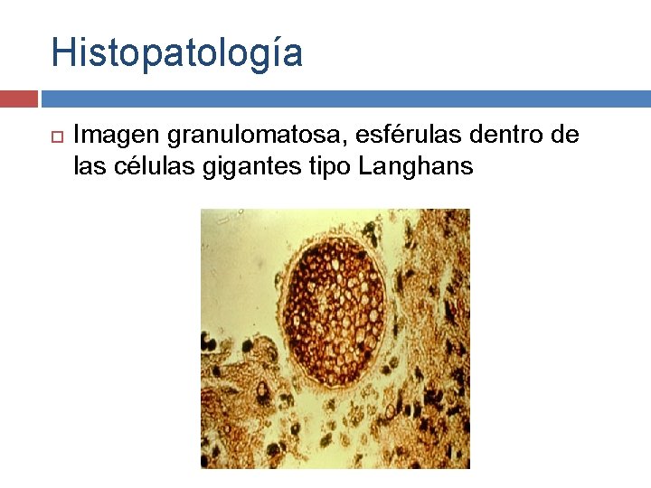 Histopatología Imagen granulomatosa, esférulas dentro de las células gigantes tipo Langhans Nosologia y Clinica