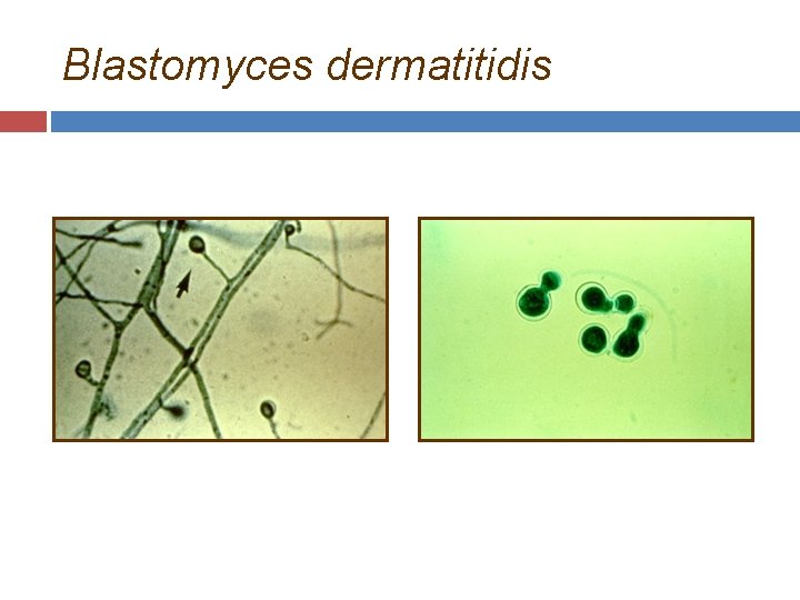 Blastomyces dermatitidis 