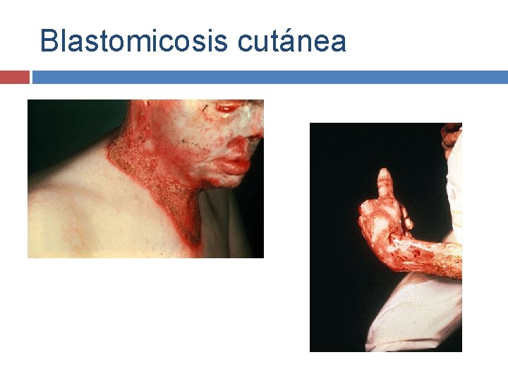 Blastomicosis cutánea 