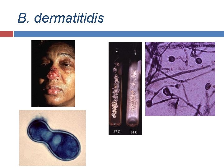 B. dermatitidis 