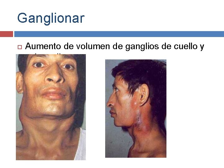 Ganglionar Aumento de volumen de ganglios de cuello y submaxilares 