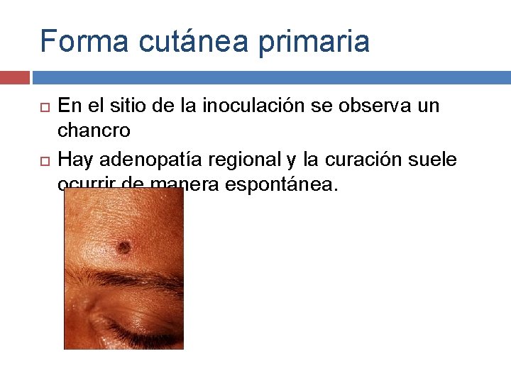 Forma cutánea primaria En el sitio de la inoculación se observa un chancro Hay