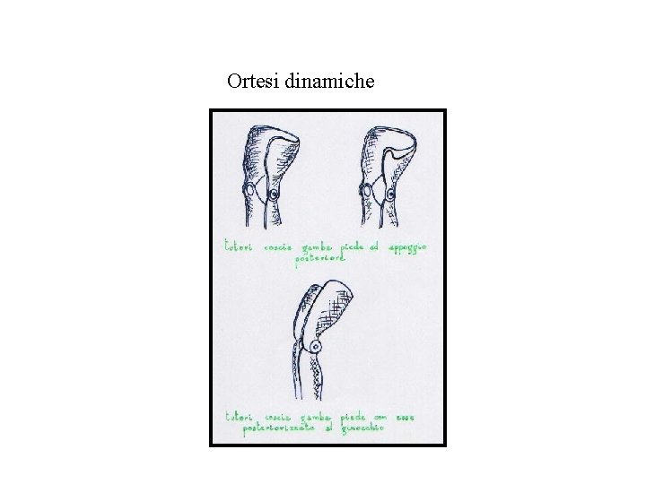 Ortesi dinamiche 