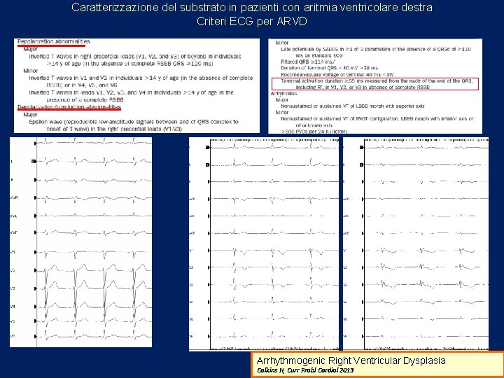 Caratterizzazione del substrato in pazienti con aritmia ventricolare destra Criteri ECG per ARVD Arrhythmogenic