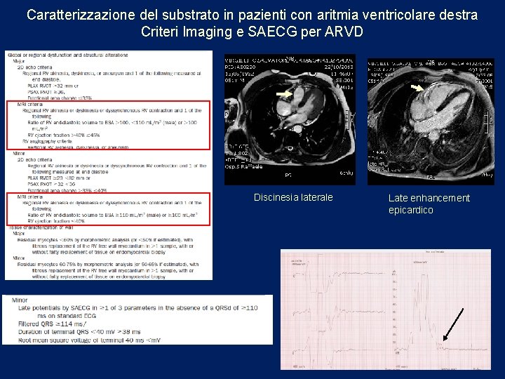 Caratterizzazione del substrato in pazienti con aritmia ventricolare destra Criteri Imaging e SAECG per