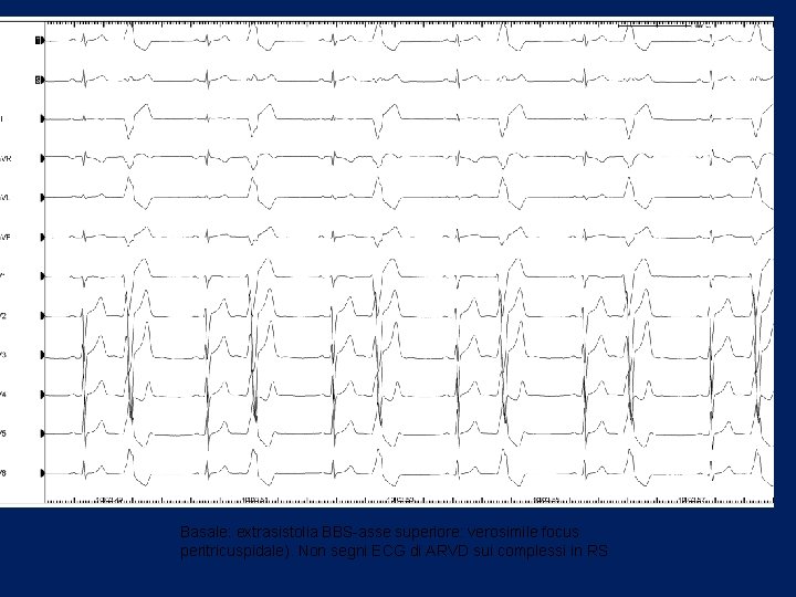 Basale: extrasistolia BBS-asse superiore: verosimile focus peritricuspidale). Non segni ECG di ARVD sui complessi