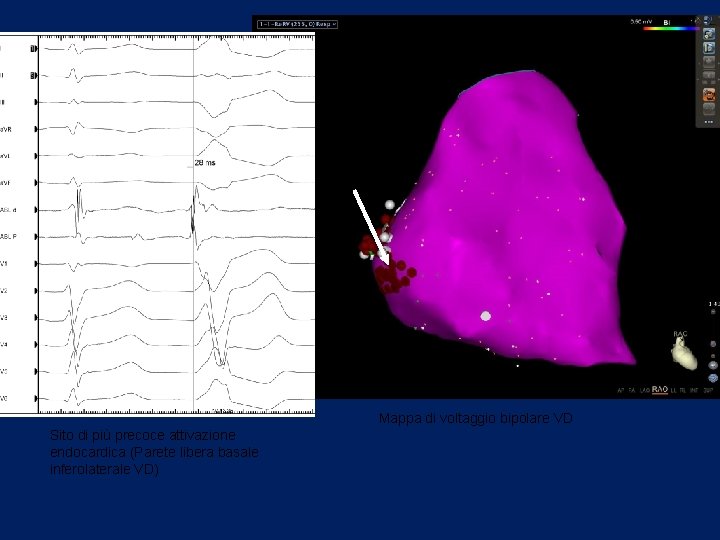 Mappa di voltaggio bipolare VD Sito di più precoce attivazione endocardica (Parete libera basale