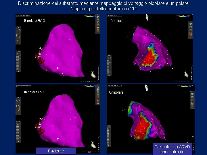 Discriminazione del substrato mediante mappaggio di voltaggio bipolare e unipolare Mappaggio elettroanatomico VD Bipolare