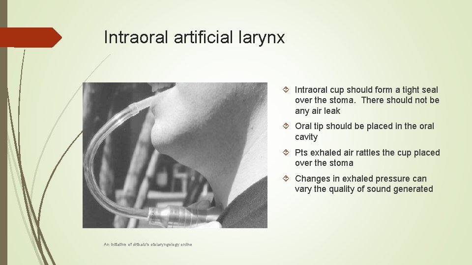 Intraoral artificial larynx Intraoral cup should form a tight seal over the stoma. There