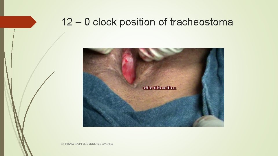 12 – 0 clock position of tracheostoma An initiative of drtbalu's otolaryngology online 