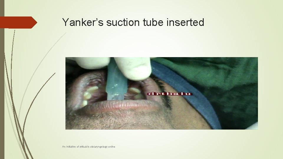 Yanker’s suction tube inserted An initiative of drtbalu's otolaryngology online 