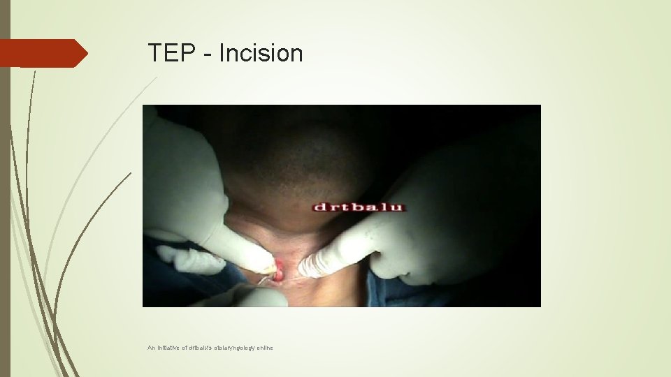 TEP - Incision An initiative of drtbalu's otolaryngology online 