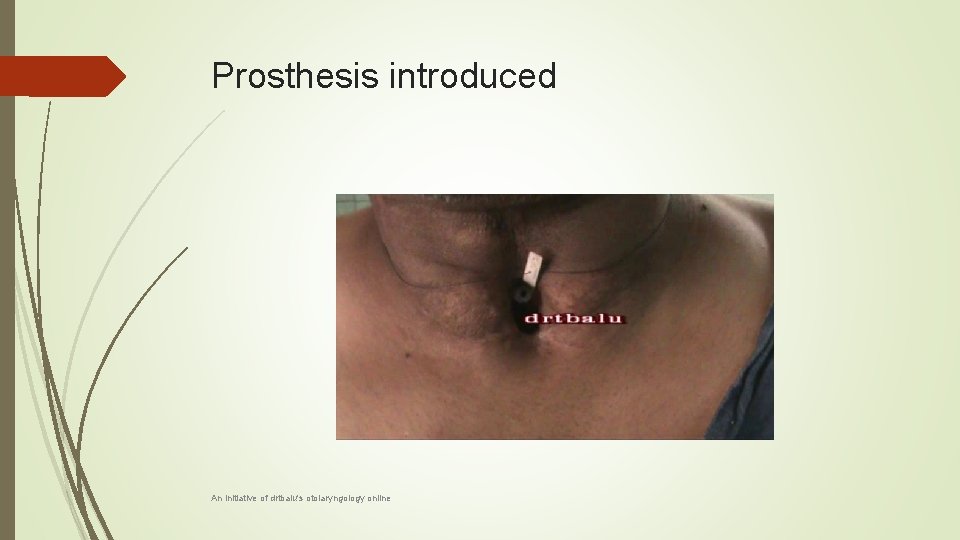 Prosthesis introduced An initiative of drtbalu's otolaryngology online 