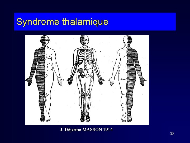 Syndrome thalamique J. Déjerine MASSON 1914 25 Syndrome thalamique J. Déjerine MASSON 1914 25