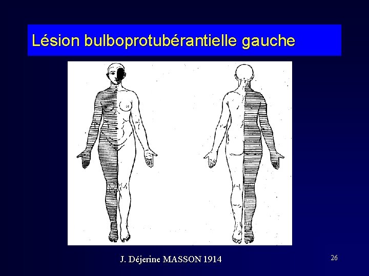 Lésion bulboprotubérantielle gauche J. Déjerine MASSON 1914 26 Lésion bulboprotubérantielle gauche J. Déjerine MASSON 1914 26