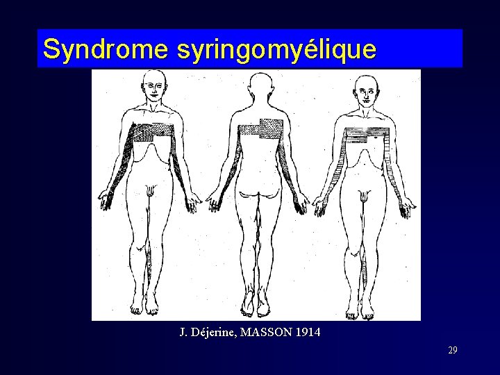 Syndrome syringomyélique J. Déjerine, MASSON 1914 29 