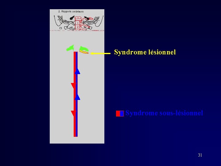 Syndrome lésionnel Syndrome sous-lésionnel 31 