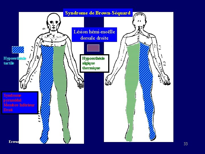 Syndrome de Brown-Séquard Lésion hémi-moëlle dorsale droite Hypoesthésie tactile Hypoesthésie algique thermique Syndrome pyramidal