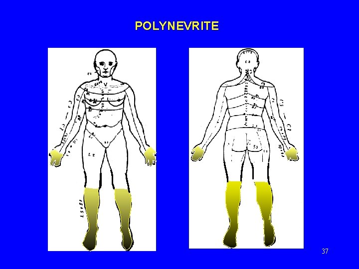 POLYNEVRITE 37 