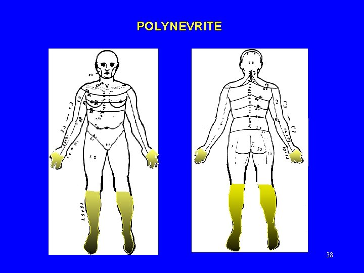 POLYNEVRITE 38 POLYNEVRITE 38