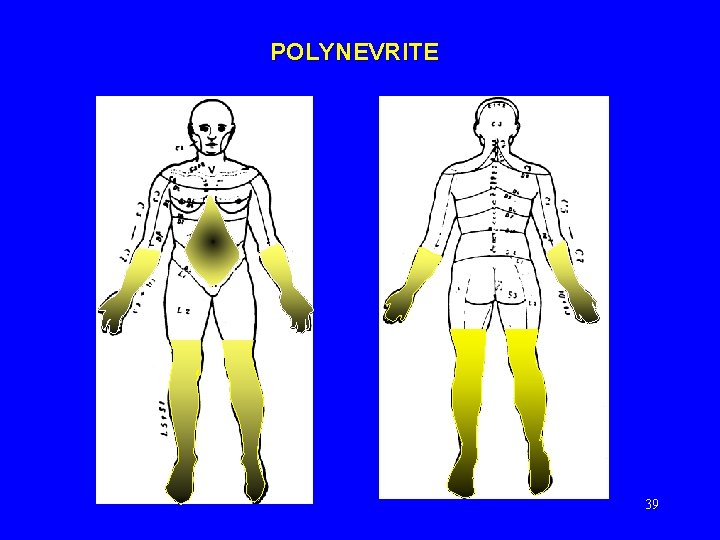 POLYNEVRITE 39 