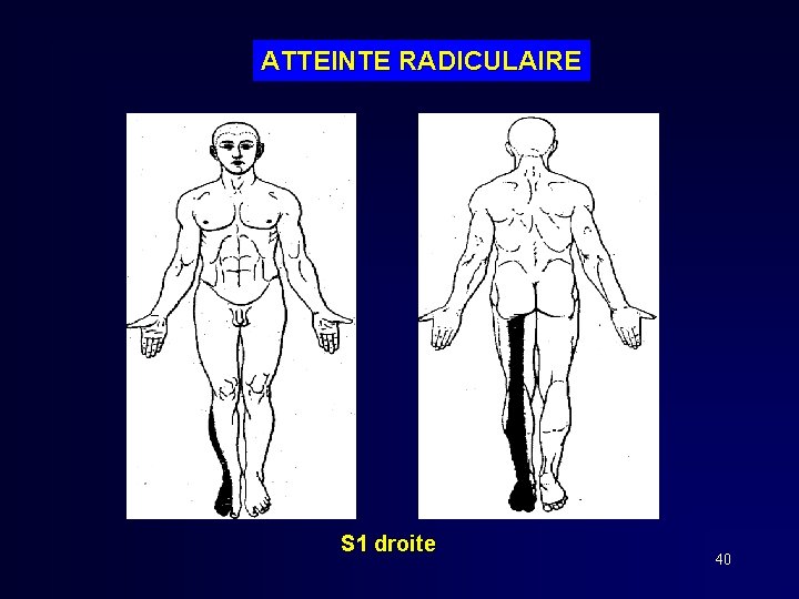 ATTEINTE RADICULAIRE S 1 droite 40 