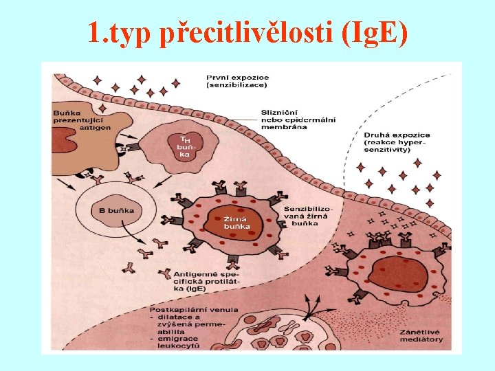 1. typ přecitlivělosti (Ig. E) 
