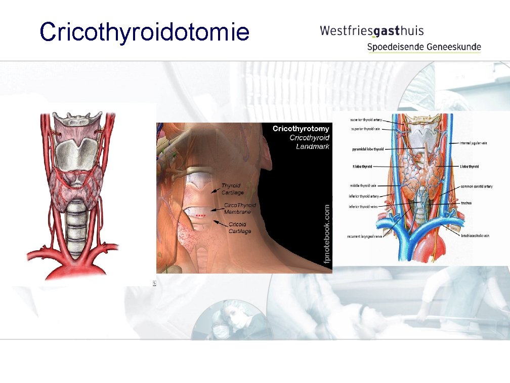 Cricothyroidotomie 