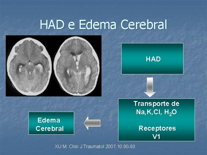 HAD e Edema Cerebral HAD Edema Cerebral Transporte de Na, K, Cl, H 2