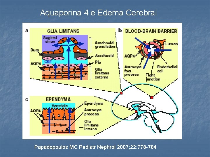 Aquaporina 4 e Edema Cerebral Papadopoulos MC Pediatr Nephrol 2007; 22: 778 -784 