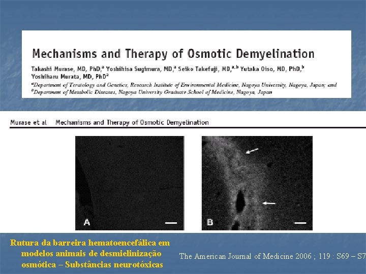 Rutura da barreira hematoencefálica em modelos animais de desmielinização osmótica – Substâncias neurotóxicas The