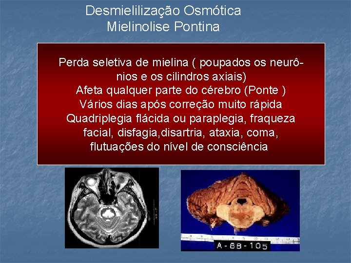 Desmielilização Osmótica Mielinolise Pontina Perda seletiva de mielina ( poupados os neurônios e os